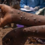 Watanzania wawili wamegundulika kuwa na virusi vya Mpox